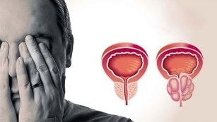 причины развития простатита у мужчин